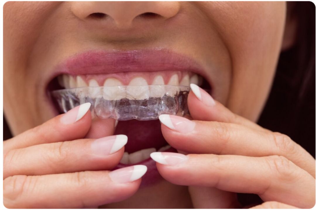 how invisible aligners are quietly transforming orthodontics